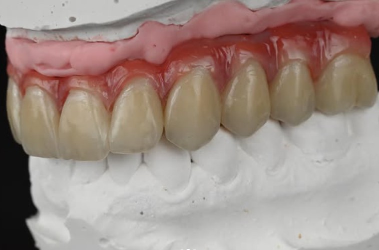Disilicate Work 2