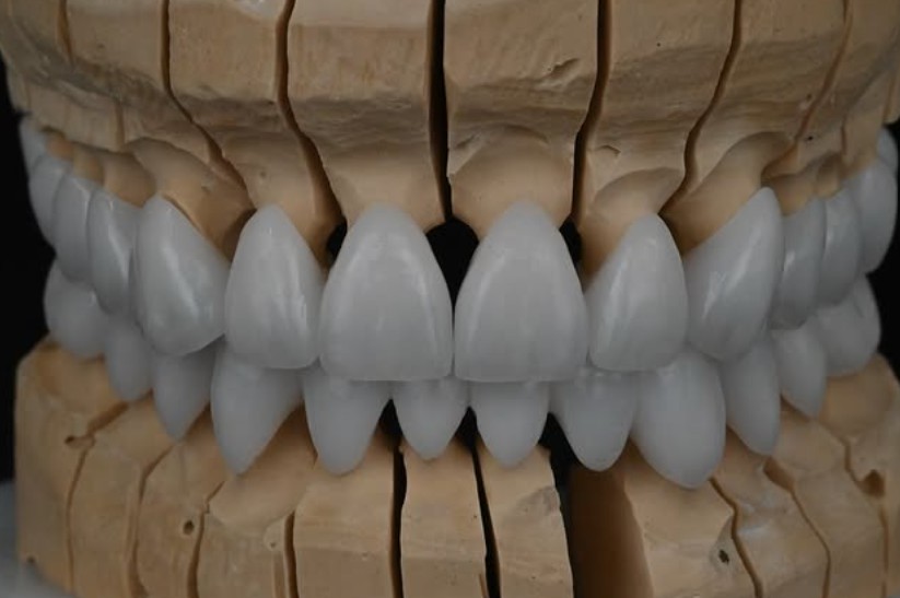 Disilicate Work 4
