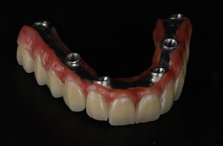 Implant Work 2