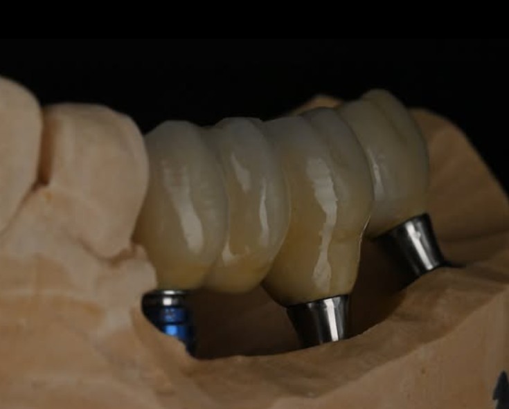 Implant Work 3