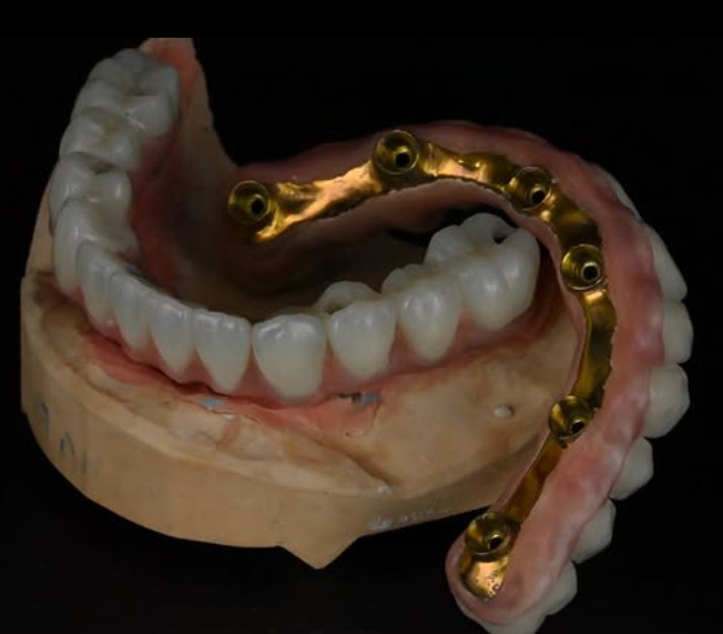 Metal Ceramic Work 4